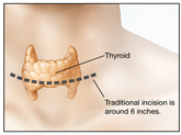 Indications for Thyroidectomy