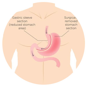 sleeve surgery in dubai