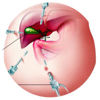 عمليات جراحة المعدة باستخدام المنظار