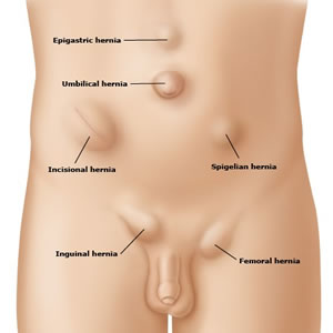 hernia surgery in dubai