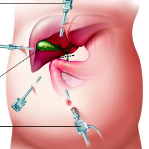 Laparoscopic Cholecystectomy surgery in dubai