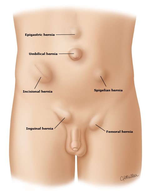 what are hernias?