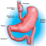 Laparoscopic Gastric Bypass