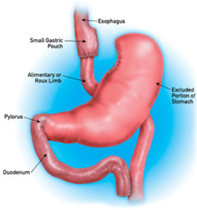 Laparoscopic Gastric Bypass