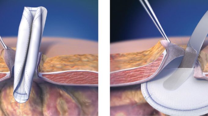 Advantages Of Keyhole Surgery Or Laparoscopic Surgery