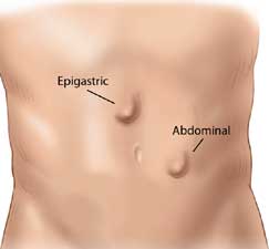 EPIGASTRIC VENTRAL HERNIA