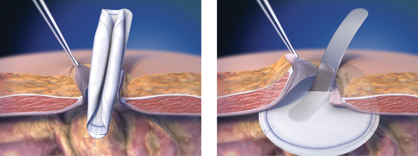 Open Repair of Umbilical Ventral Hernia