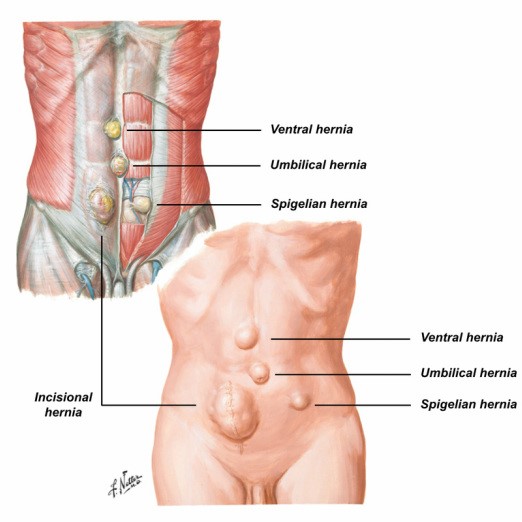 SPIGELIAN VENTRAL HERNIA