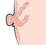 Umbilical Ventral Hernia