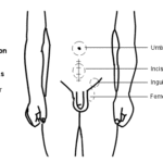 Why Do Hernia Occurs