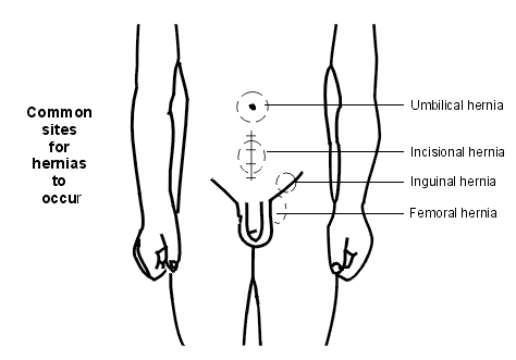 why do hernia occurs