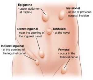 Hernia Repair In Dubai | Hernia Repair Surgery In Dubai