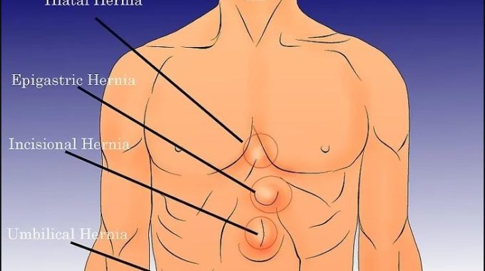 How To Know If You Have A Hernia