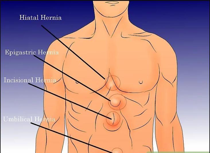 How to know if you have a Hernia