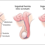 Inguinal Hernia