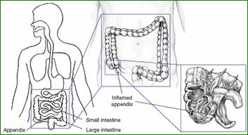 Laparoscopic Appendectomy