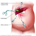 Laparoscopic Cholecystectomy Surgery In Dubai