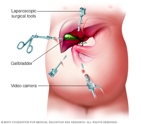 Laparoscopic Cholecystectomy surgery in dubai