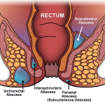 Anal Fistula Surgery In Dubai