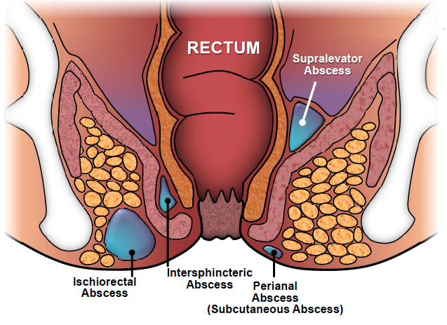 Anal Fistula surgery in dubai