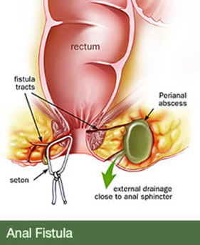 Anal Fistula surgery in dubai