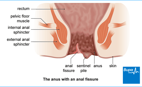 Anal Fissure surgery in dubai
