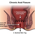 Anal Fissure Surgery In Dubai