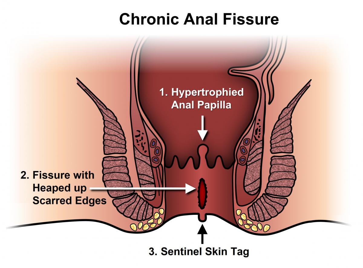 Anal Fissure surgery in dubai