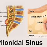 Pilonidal Sinus Surgery In Dubai