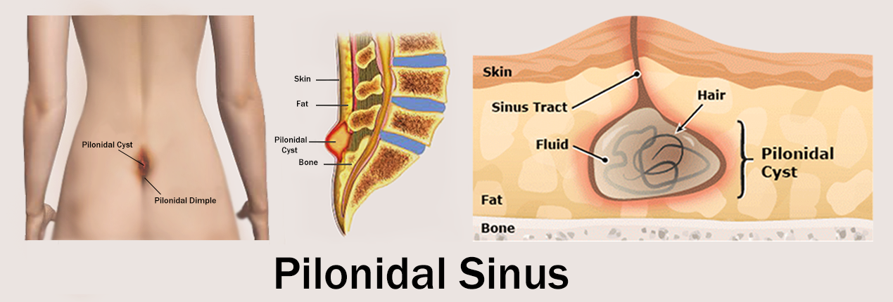 Pilonidal Sinus surgery in dubai