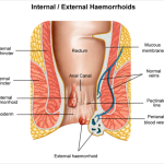 Haemorrhoids Surgery In Dubai