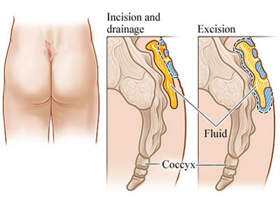 Pilonidal Sinus surgery in dubai