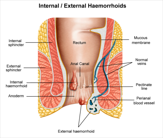 Haemorrhoids surgery in dubai