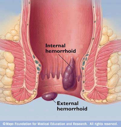 Haemorrhoids surgery in dubai