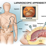 Appendicitis Surgery In Dubai