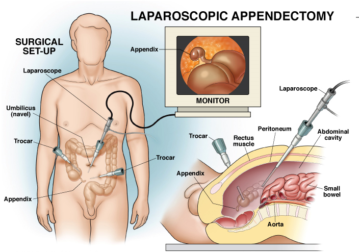 Appendicitis surgery in dubai