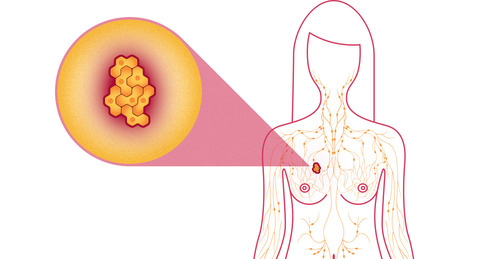 Diagnosis for Carcinoma Breast