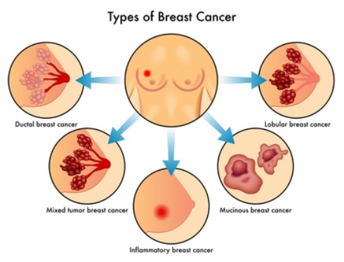 breast lump in dubai