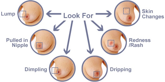 Breast lump diagram  Natural breast, Breast health, Breast