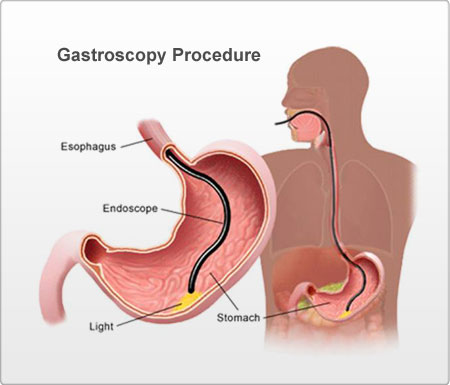 Gastroscopy and Associated Procedures in dubai