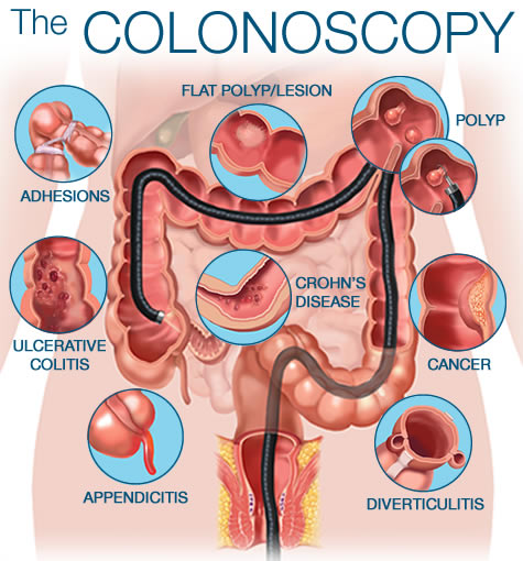 colonoscopy surgery in dubai