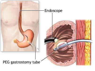 Endoscopic Gastrostomy ( PEG ) surgery in dubai