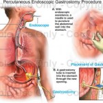 Endoscopic Gastrostomy ( PEG ) Surgery In Dubai
