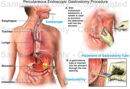 Endoscopic Gastrostomy ( PEG ) surgery in dubai