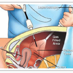 Diagnostic Laparoscopy Surgery In Dubai