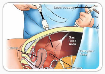 Diagnostic Laparoscopy surgery in dubai