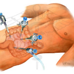 Laparoscopic Colon Surgery For Diverticular Disease And Cancer