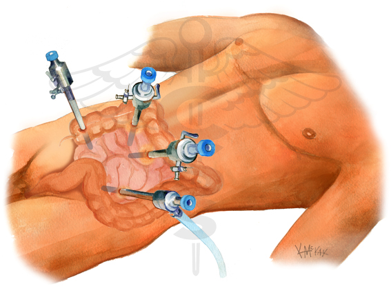 Laparoscopic Colon surgery for diverticular disease and cancer