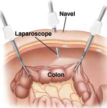 Colon Cancer in dubai