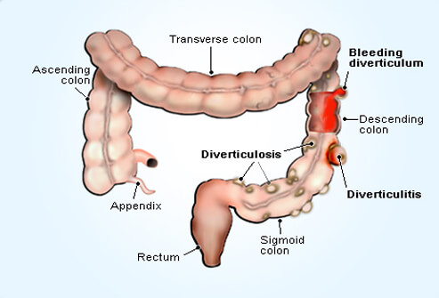 Diverticulitis surgery in dubai